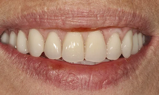 Casos de sucesso Dentes 12h - depois