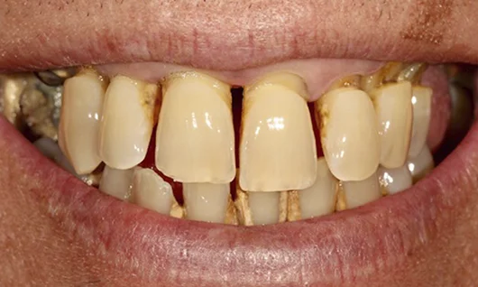 Casos de sucesso Dentes 12h - antes