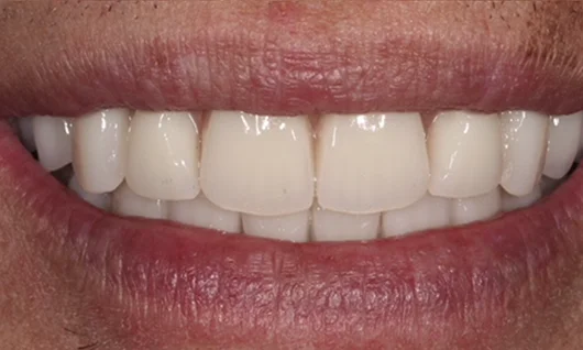 Casos de sucesso Dentes 12h - depois